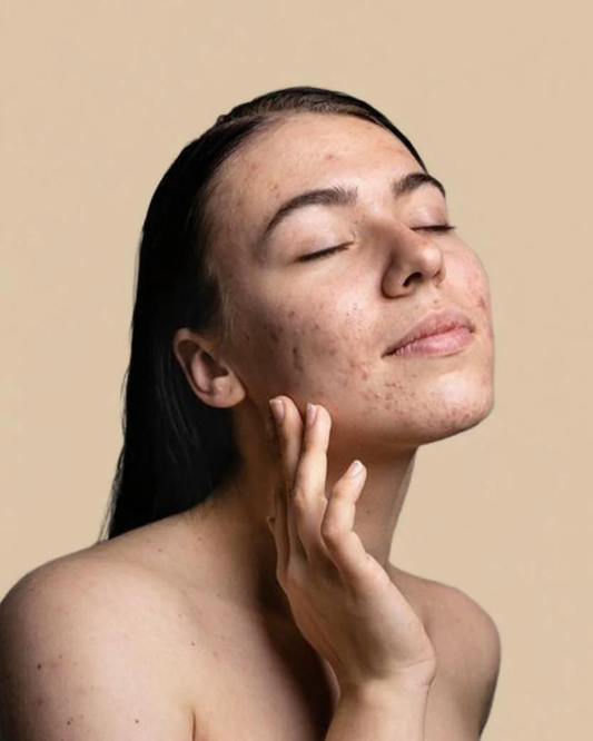 Acne Control